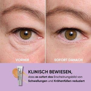 Temporärer Augenstraffer