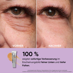 Temporärer Augenstraffer