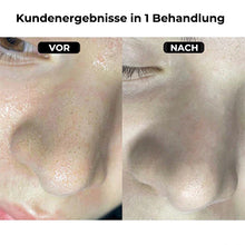 Laden Sie das Bild in den Galerie-Viewer, Mitesser-Reinigungsgerät