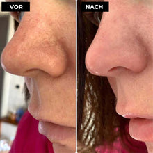 Laden Sie das Bild in den Galerie-Viewer, Mitesser-Reinigungsgerät